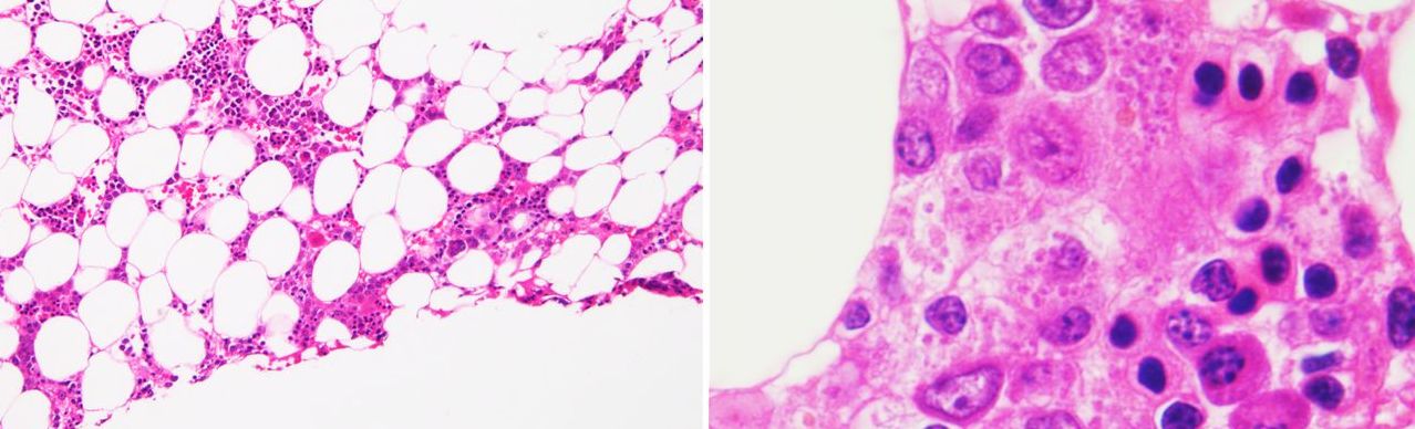 Hemophagocytic lymphohistiocytosis Hemophagocytic lymphohistiocytosis
